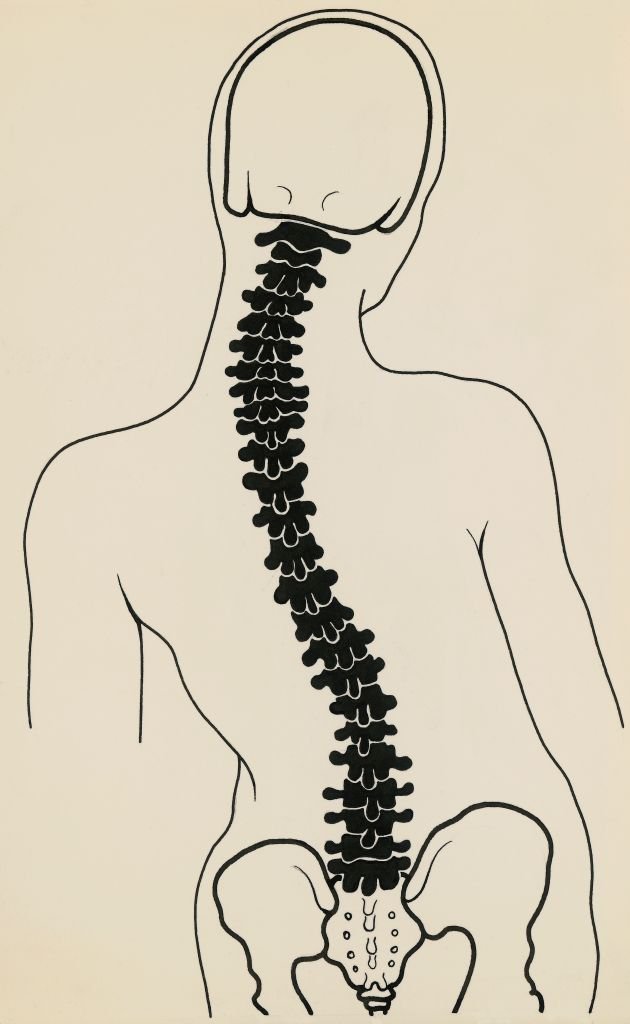 Colonne vertébrale avec scoliose.| Photo : Getty Images
