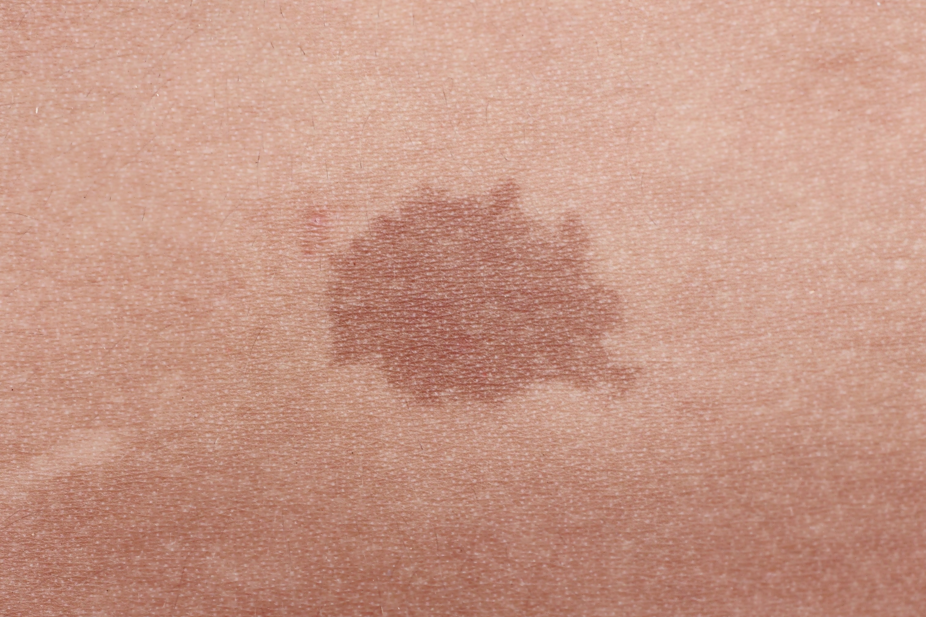 Brown birthmark. | Source: Shutterstock