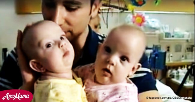 Conjoined twins separated 12 years ago have matured into unique individuals