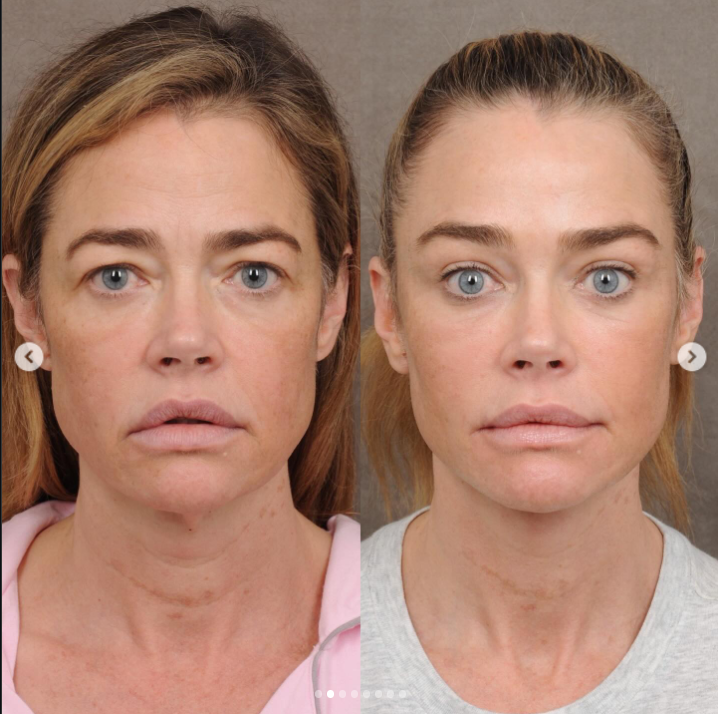 Denise Richards' before and after — Frontal view (neutral expression) | Source: Instagram/drbentalei | deniserichards