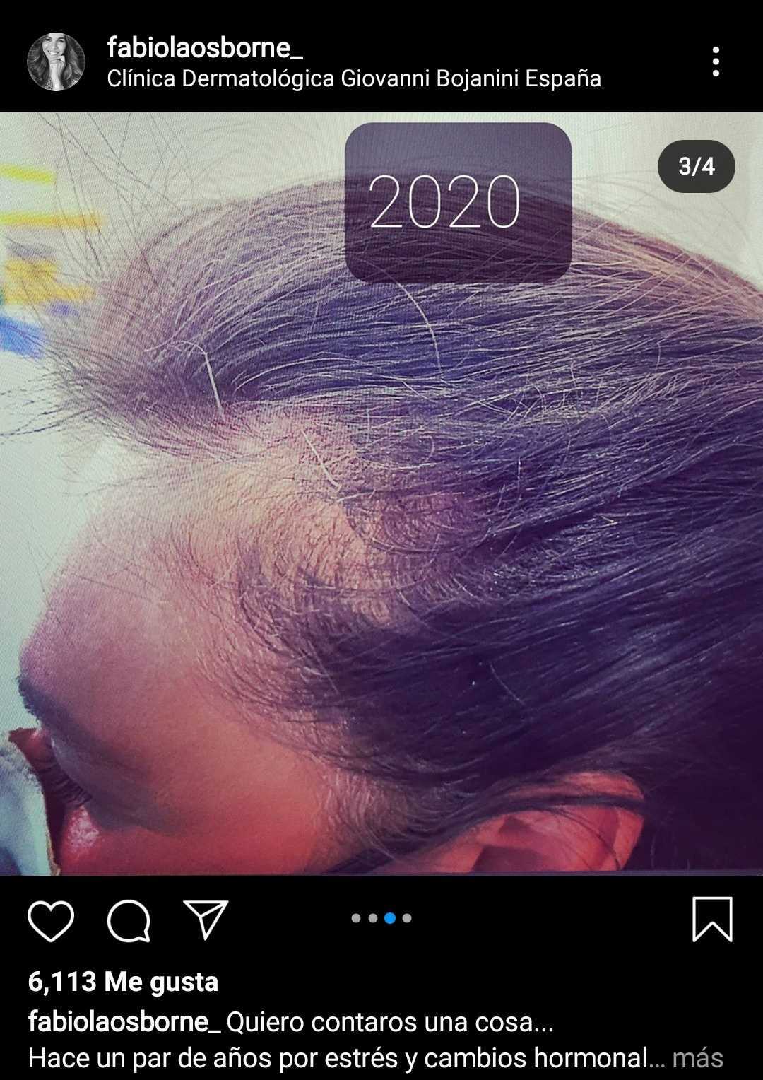 Captura de foto de la caída capilar de Fabiola Martínez. | Foto: Instagram/fabiolaosborne_/ Captura de foto de la caída capilar de Fabiola Martínez. | Foto: Instagram/fabiolaosborne_/