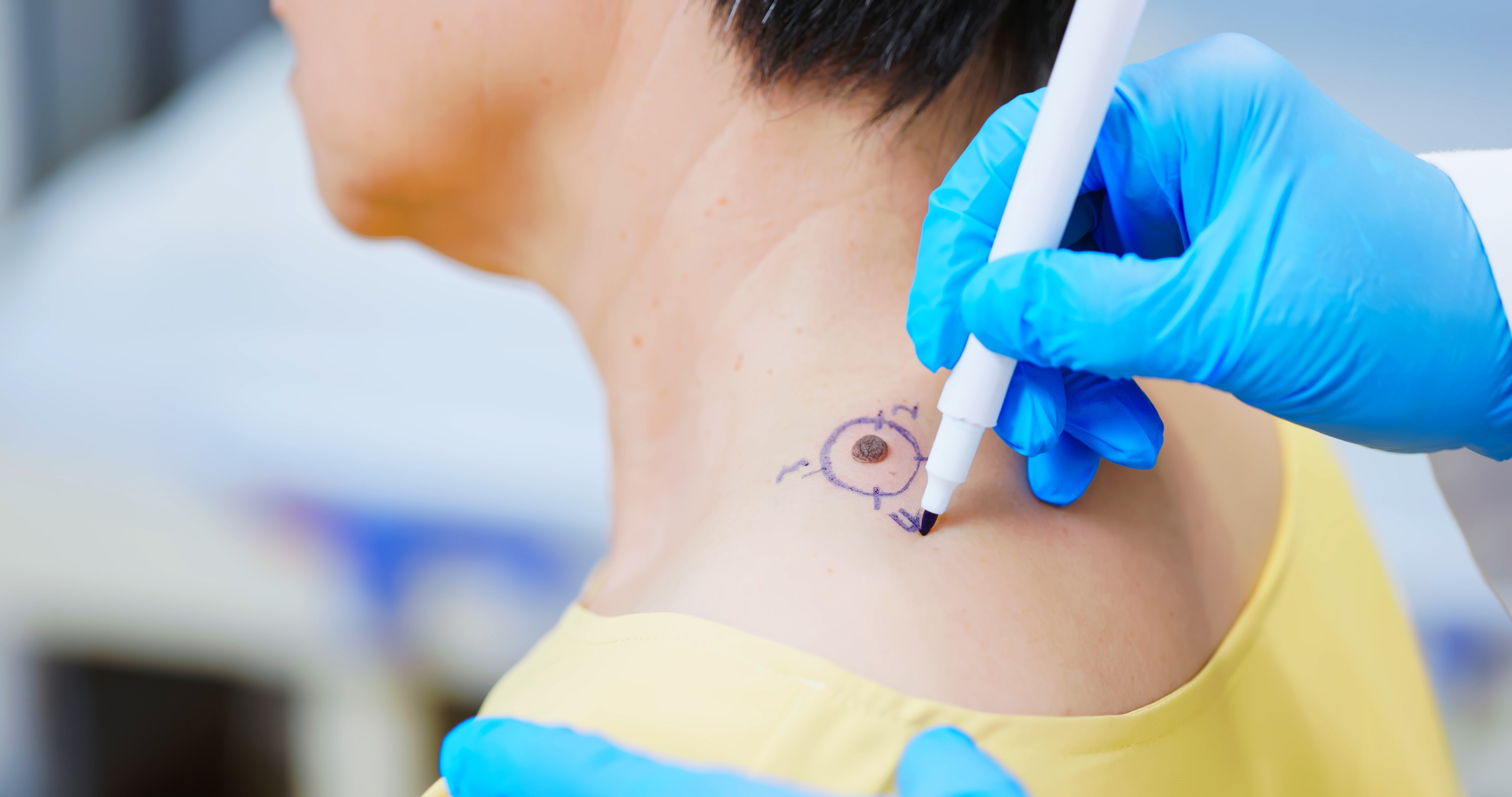 Close-up of a woman's shoulder mole being marked for treatment by a doctor | Source: Getty Images.