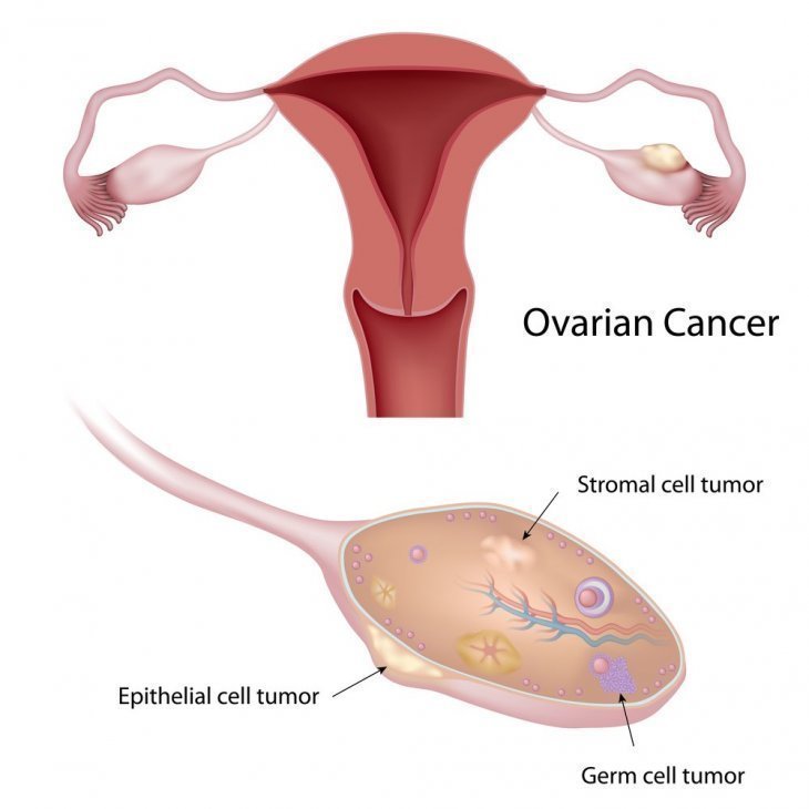 Cáncer de ovario. | Imagen: Shutterstock Cáncer de ovario. | Imagen: Shutterstock