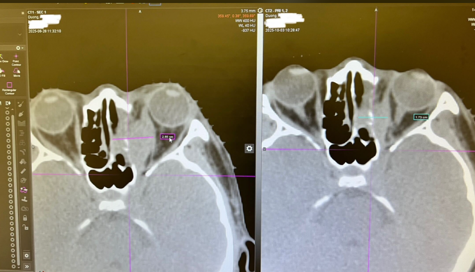Side-by-side CT scan images of Alex Duong’s eye area, showing detailed cross-sections of the orbital region with measurement markers highlighting areas of concern. | Source: GoFundMe