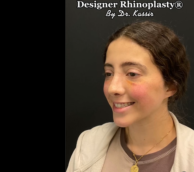 Patient pictured after rhinoplasty, dated June 15, 2022 | Source: Instagram/drkassir