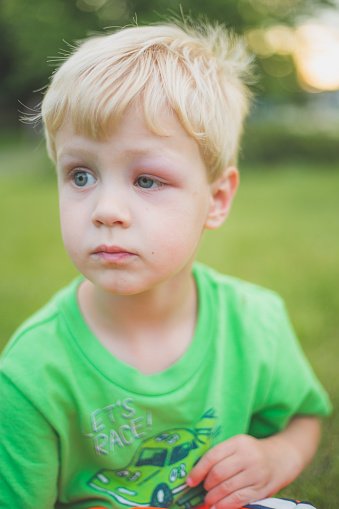 Photo of a little boy with bond hair and a black eye sits outside | Photo: Getty Images