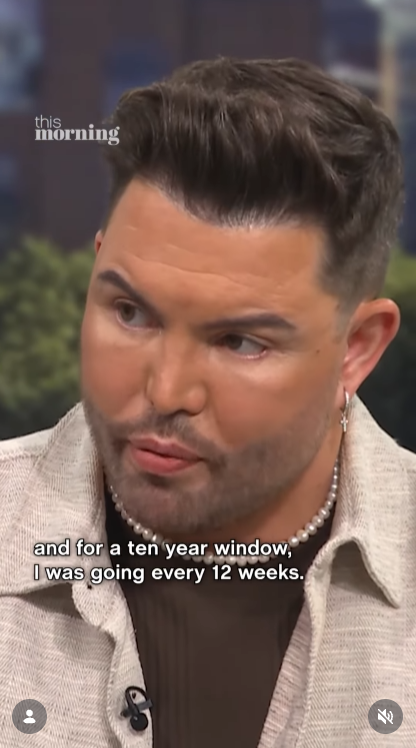 Another tight close-up from the same interview, this time showing Norris in profile — his newly sculpted jawline and a small cross earring catching the light as he reflects on his cosmetic history. | Source: Instagram/thismorning