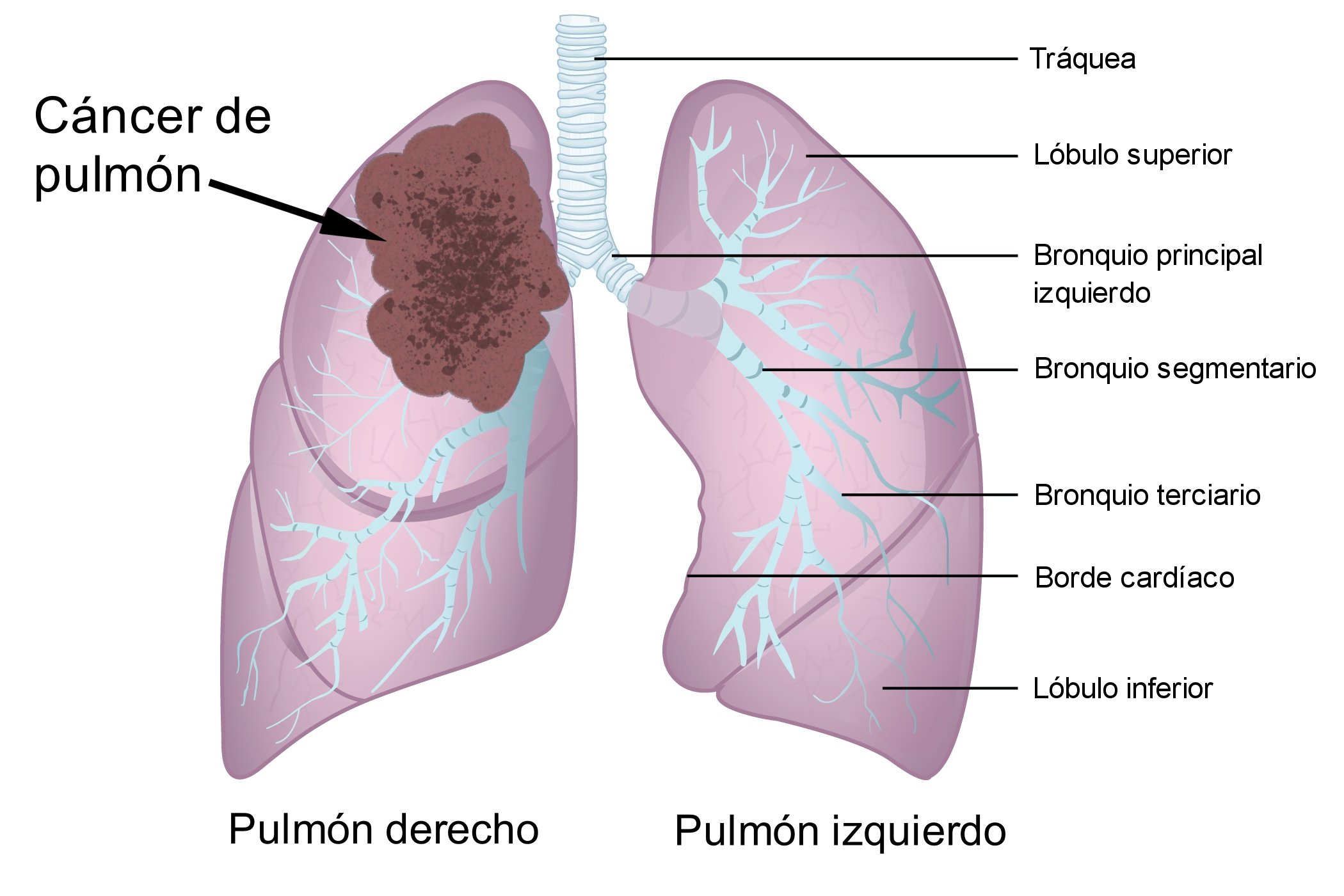 Infographie pulmonaire avec cancer. | Photo : Wikimedia Infographie pulmonaire avec cancer. | Photo : Wikimedia