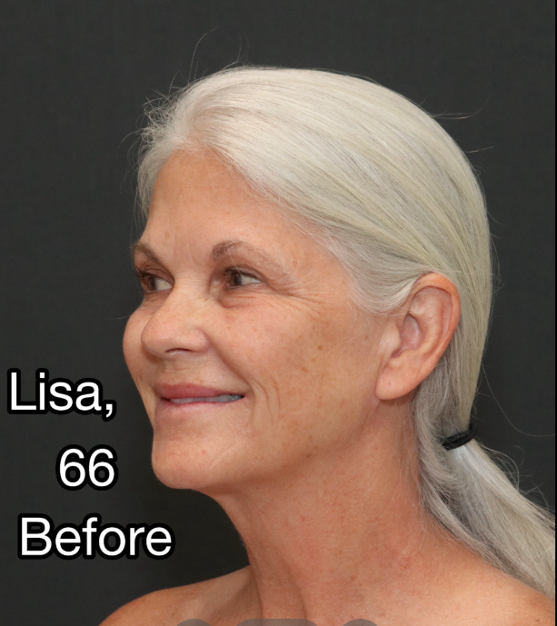 Lisa poses before the procedures, dated April 3, 2025 | Source: TikTok/@nayakplasticsurgery