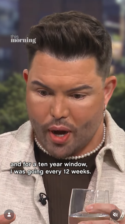 A close-up of Norris during his "This Morning" interview, his freshly lifted features and pearl necklace visible as he speaks openly about his decade of regular filler appointments. | Source: Instagram/thismorning