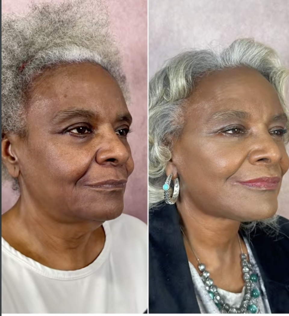 A screenshot of Linda Truesdale before and after getting a facelift from a post dated February 27, 2025. | Source: TikTok/doctor.truesdale