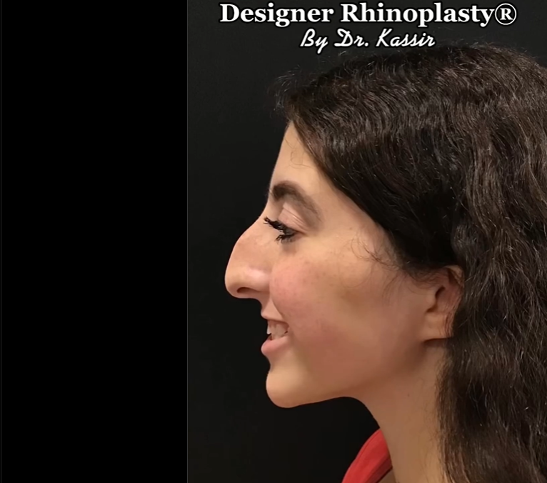 Patient photographed before rhinoplasty, dated June 15, 2022 | Source: Instagram/drkassir
