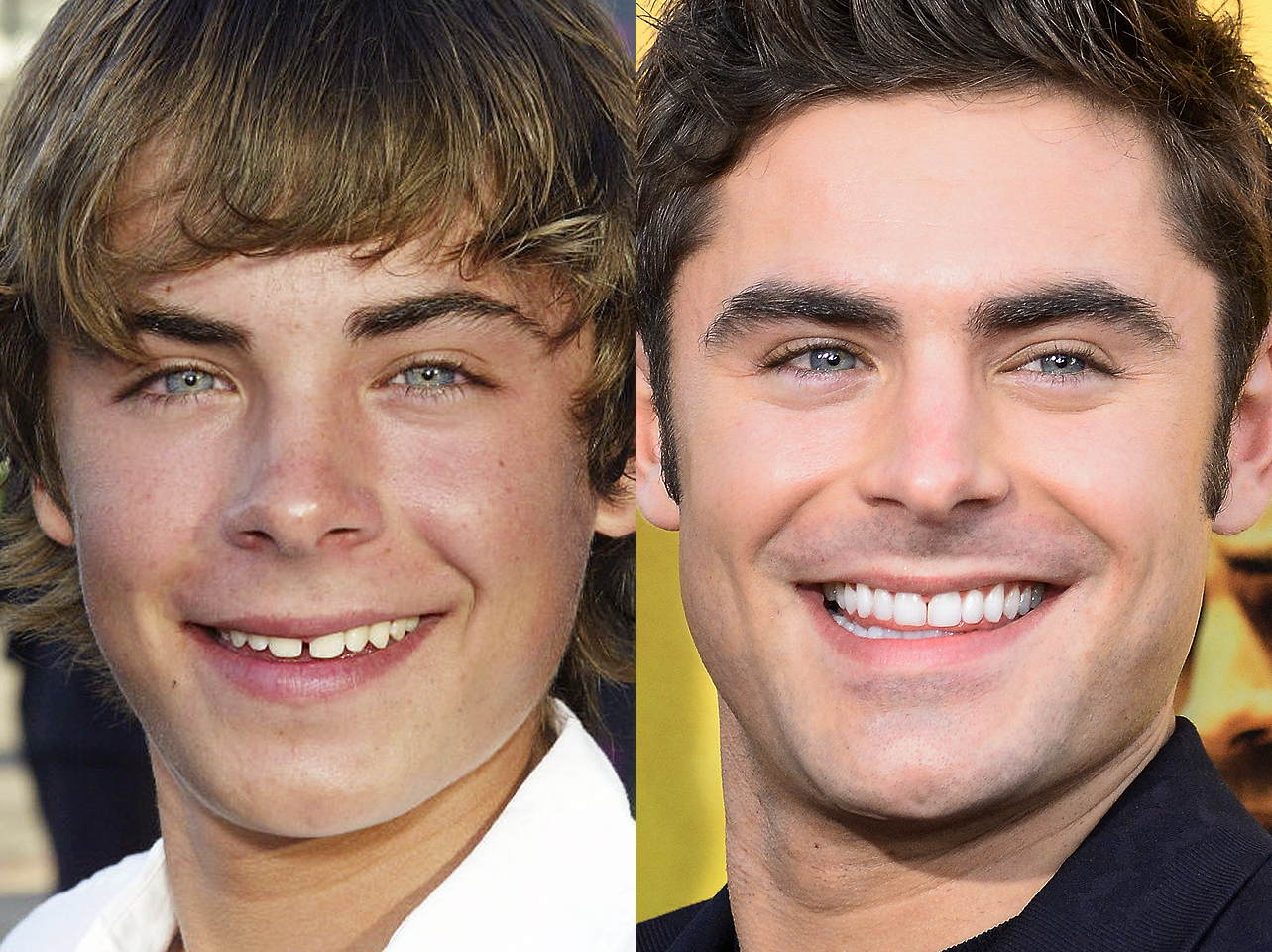 A before and after of Zac Efron's smile. | Source: Getty Images
