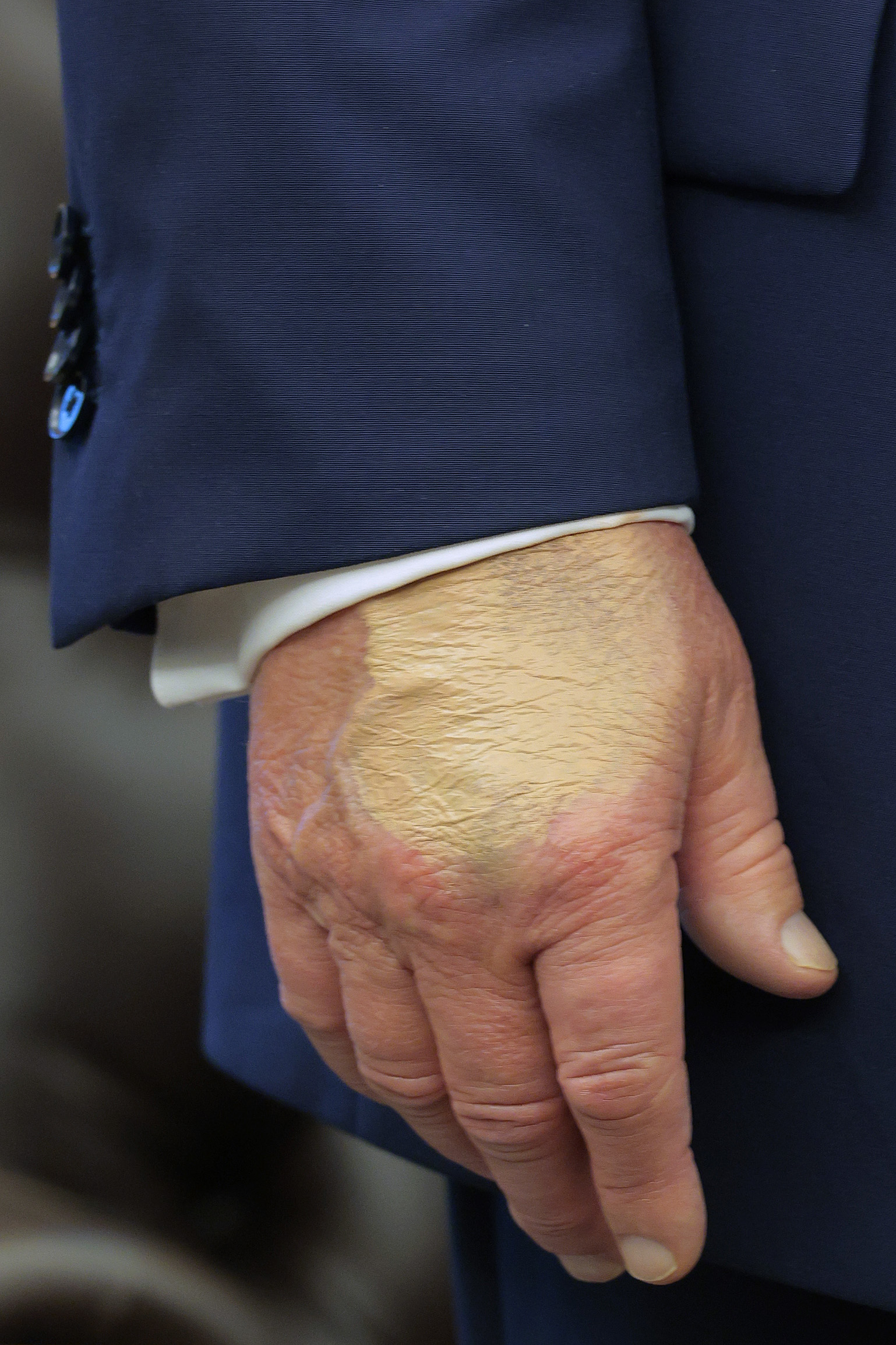 A patch of discolored skin is visible on Donald Trump's hand as he talks about the FIFA World Cup at the White House on August 22, 2025 | Source: Getty Images
