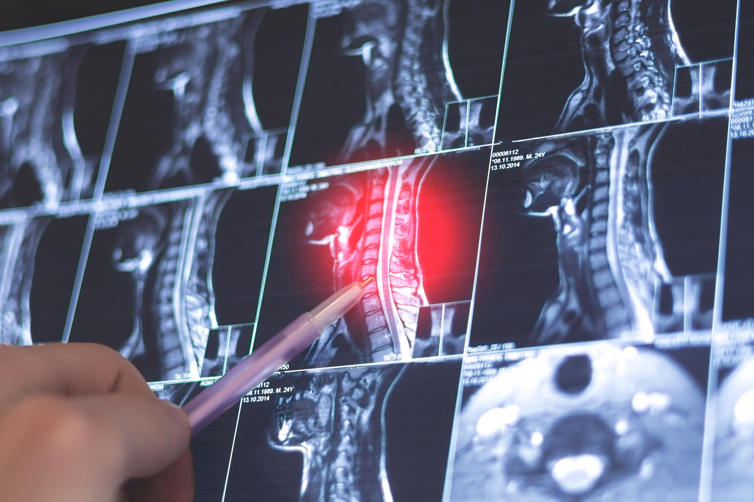 MRI of the cervical spine showing suspected spondylosis with nerve root compression, reviewed by a physician for signs of radiculopathy and chronic neck pain | Source: Getty Images
