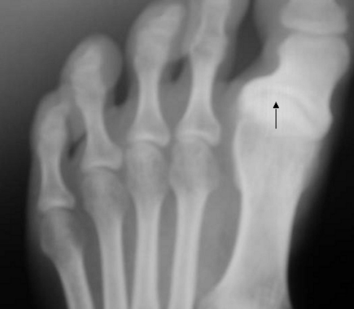 Un pied atteint de l'arthrose. | Wikimedia Commons Un pied atteint de l'arthrose. | Wikimedia Commons