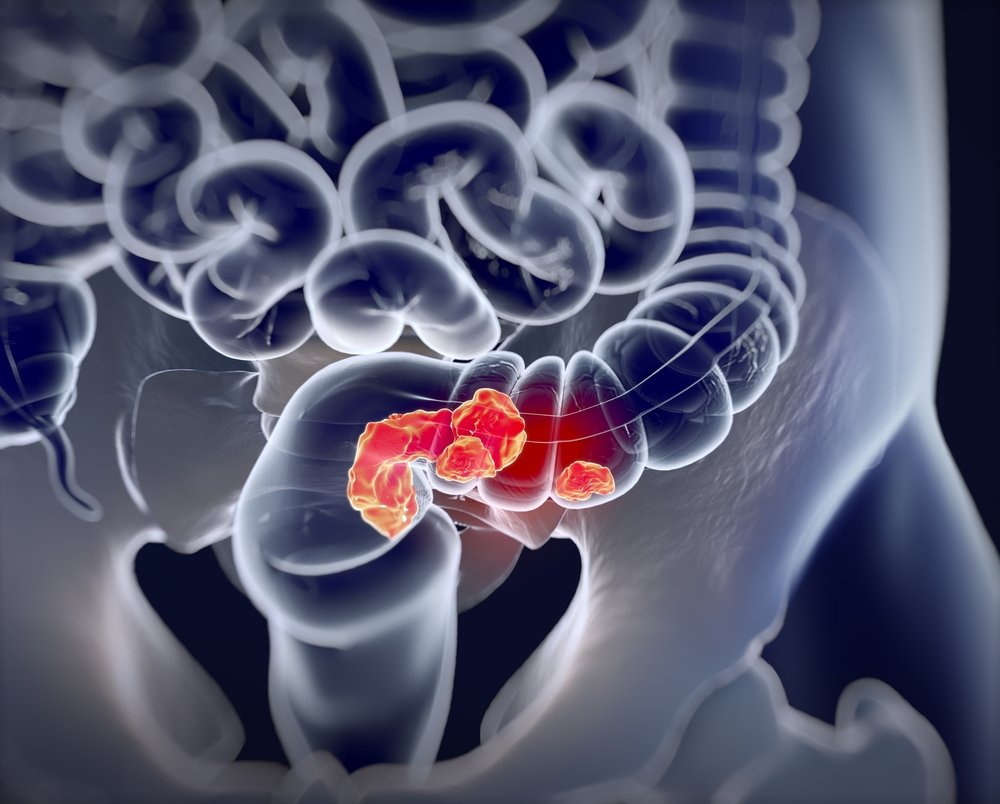 cancer colorectal / Source : Shutterstock cancer colorectal / Source : Shutterstock