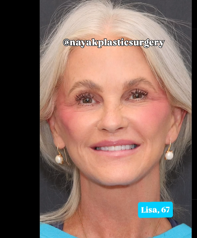 Lisa smiles for the camera, post-op, seen in a post dated June 1, 2025 | Source: Instagram/nayakplasticsurgery