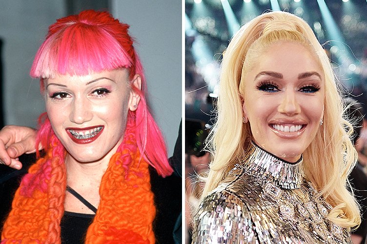 Gwen Stefani avant et après. ǀ Source : Getty Images