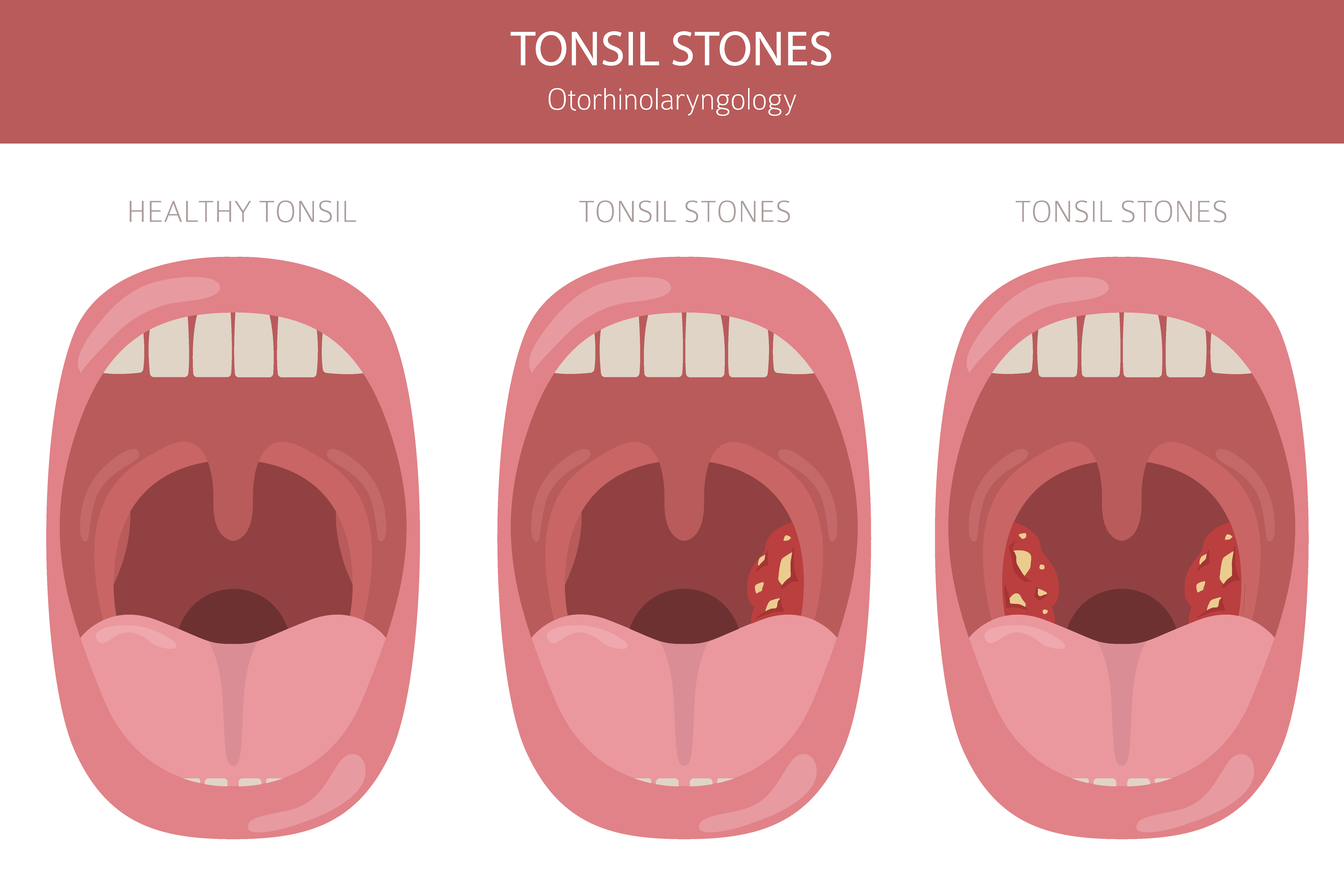 Vector illustration of tonsil stones | Source: Getty images