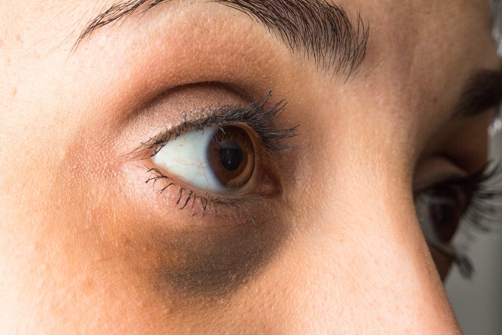 Círculos oscuros debajo de los ojos. | Foto: Shutterstock Círculos oscuros debajo de los ojos. | Foto: Shutterstock