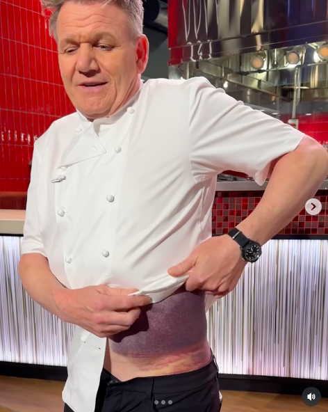 Gordon Ramsay revealing his huge, purple bruise from his bike accident, posted on June 15, 2024. | Source: Instagram/gordonramsay