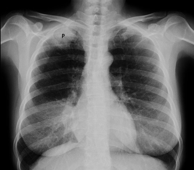 Radiographie thoracique. | Photo : Wikimedia Commons Radiographie thoracique. | Photo : Wikimedia Commons