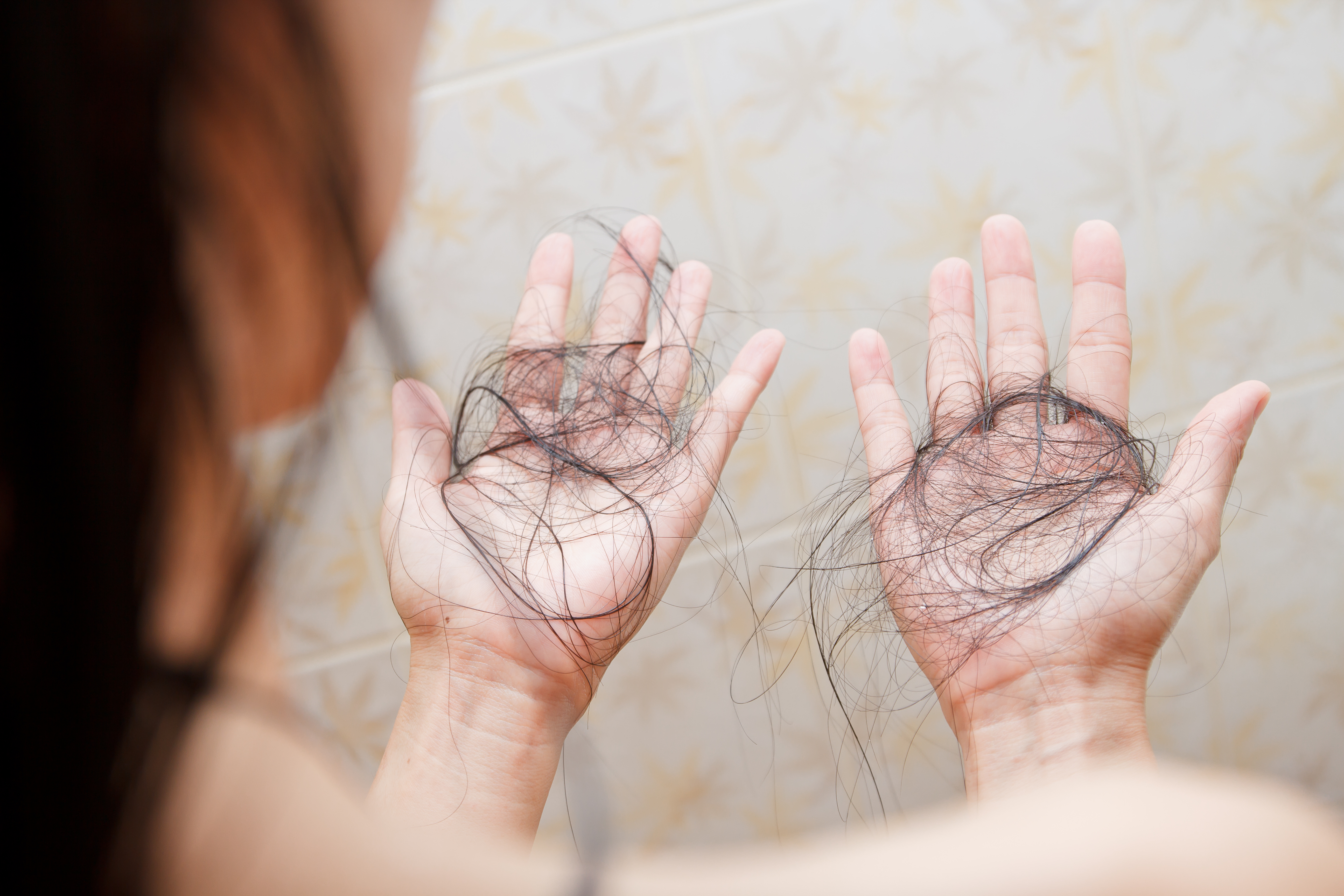 Eine Person, die unter Haarausfall leidet | Quelle: Shutterstock
