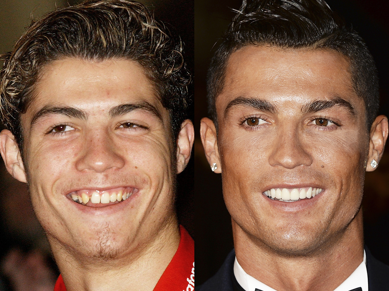 A before and after of Cristiano Ronaldo's smile. | Source: Getty Images
