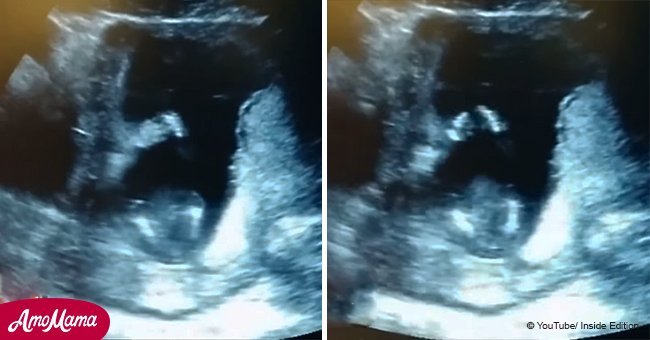 Couple wanted to announce pregnancy. Then ultrasound captured their child clapping