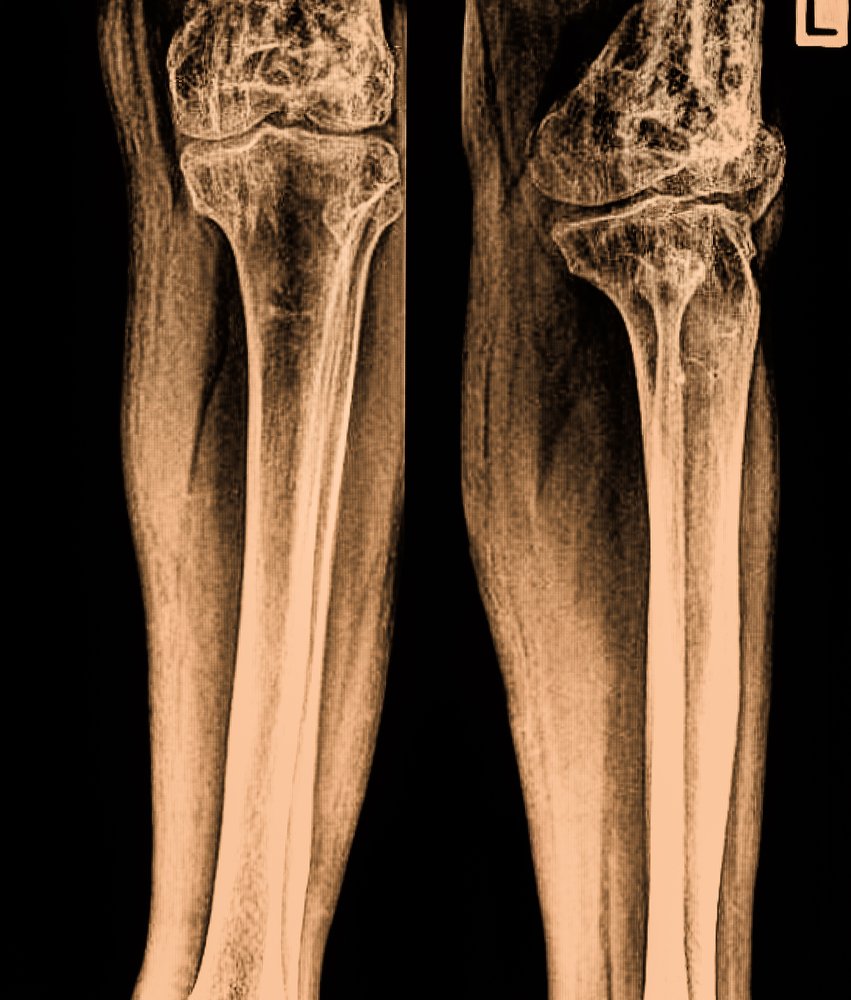 Des os de jambes. | Photo : Shutterstock. Des os de jambes. | Photo : Shutterstock.