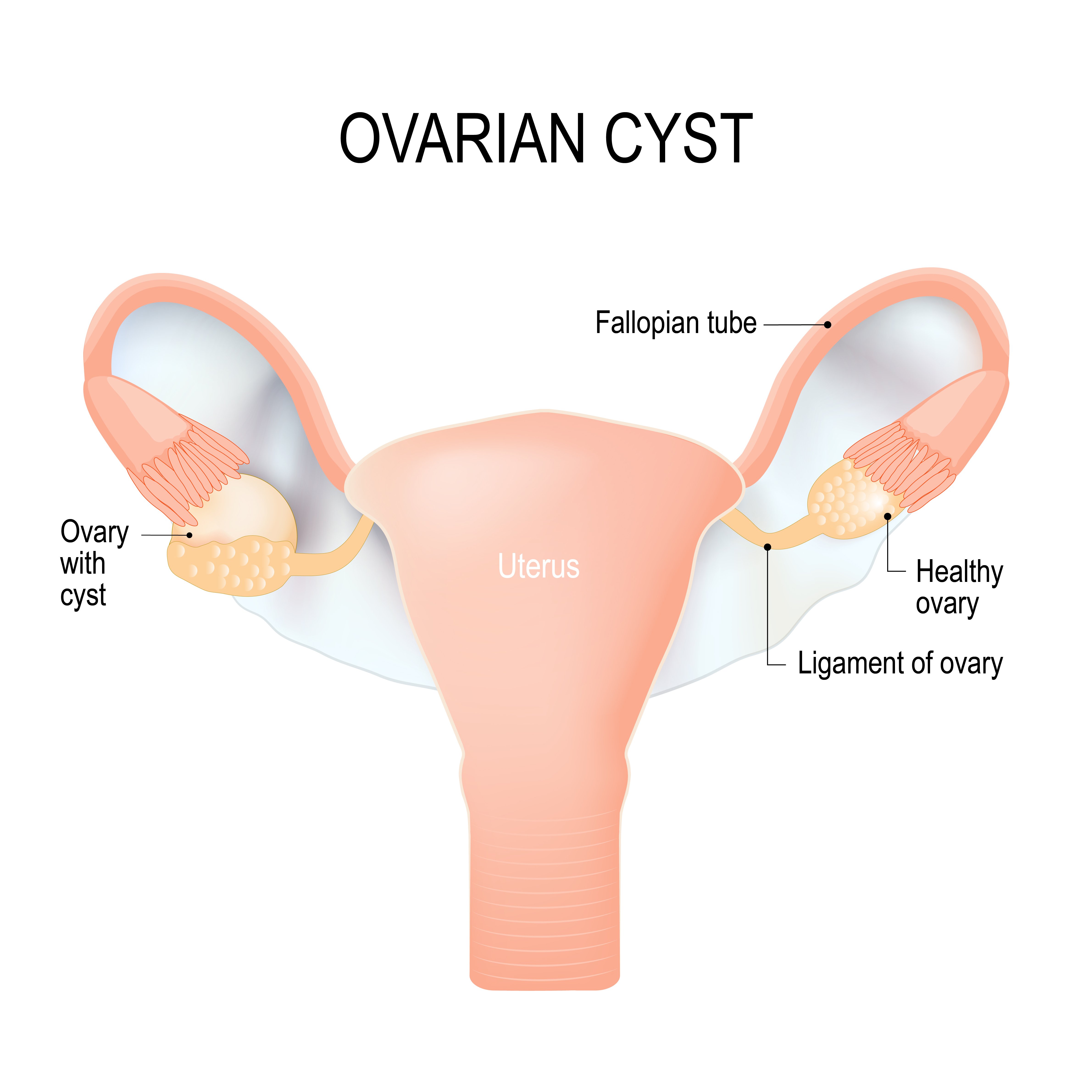 Les kystes ovariens. l Source: Shutterstock Les kystes ovariens. l Source: Shutterstock