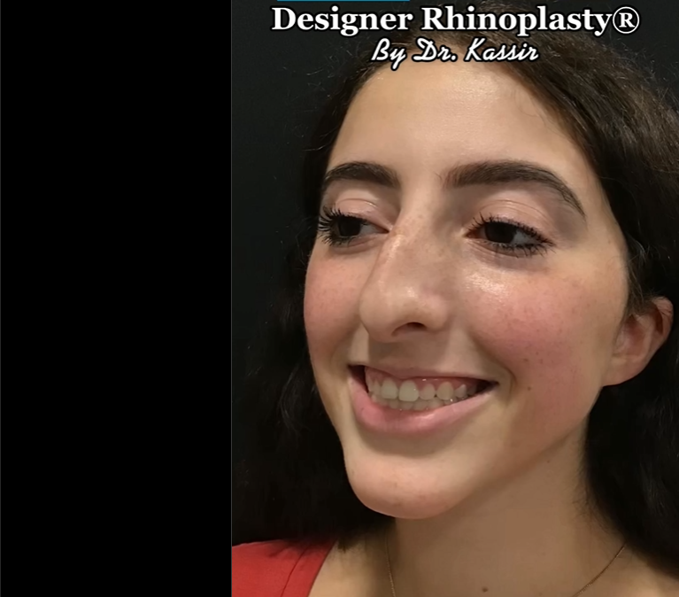 Patient before rhinoplasty | Source: Instagram/drkassir