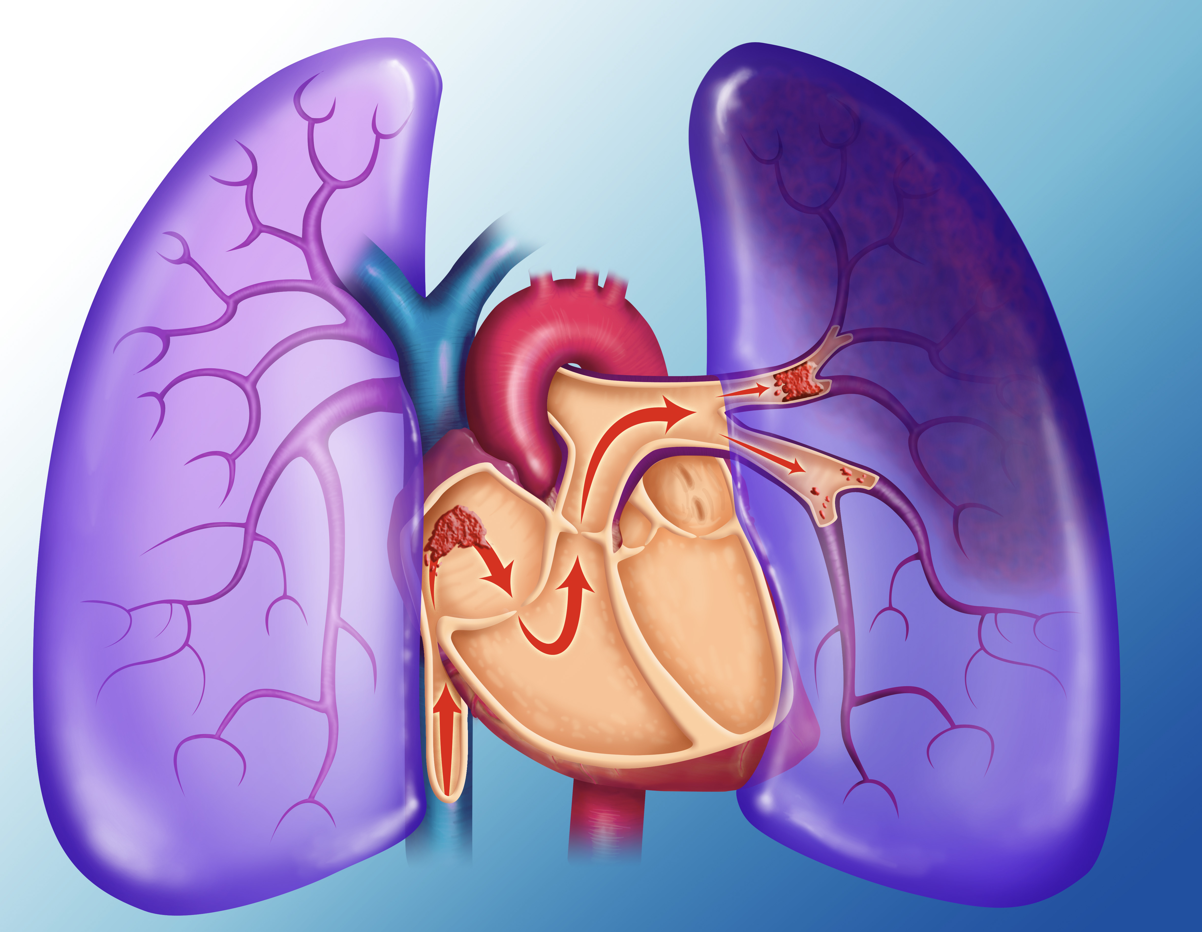 An illustration depicting a pulmonary embolism: a blood clot travels through the heart to the lungs, where it becomes lodged in small pulmonary arterioles, blocking blood flow and causing ischemia. | Source: Getty Images