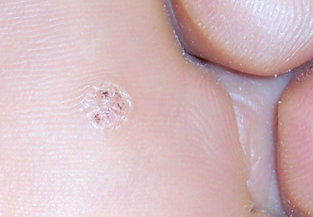 Verrue plantaire causée par le papillomavirus (VPH). l Source: Wikipedia