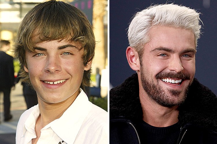 Zac Efron avant et après. ǀ Source : Getty Images