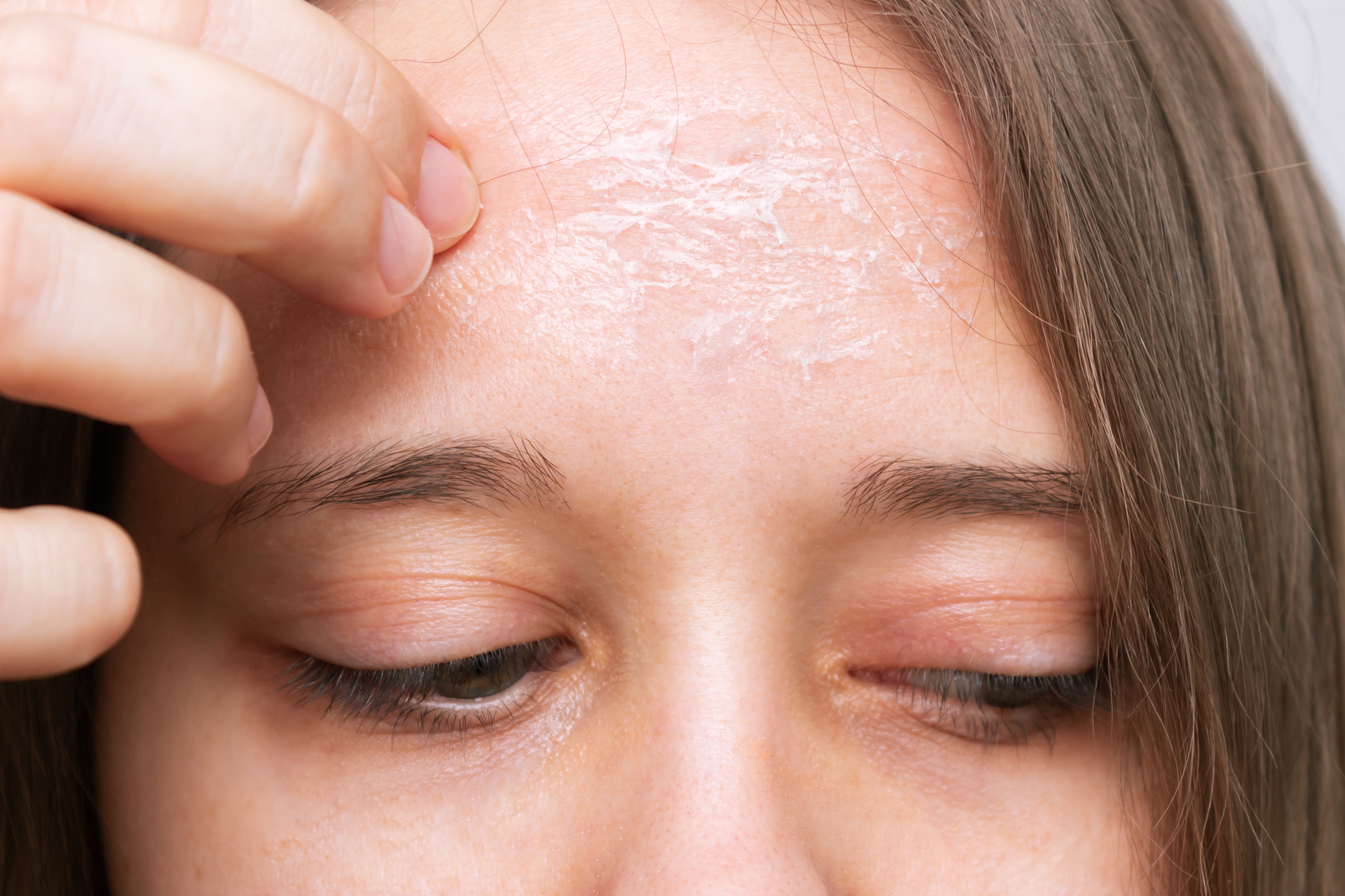 A close-up of a woman's forehead with dry skin | Source: Shutterstock