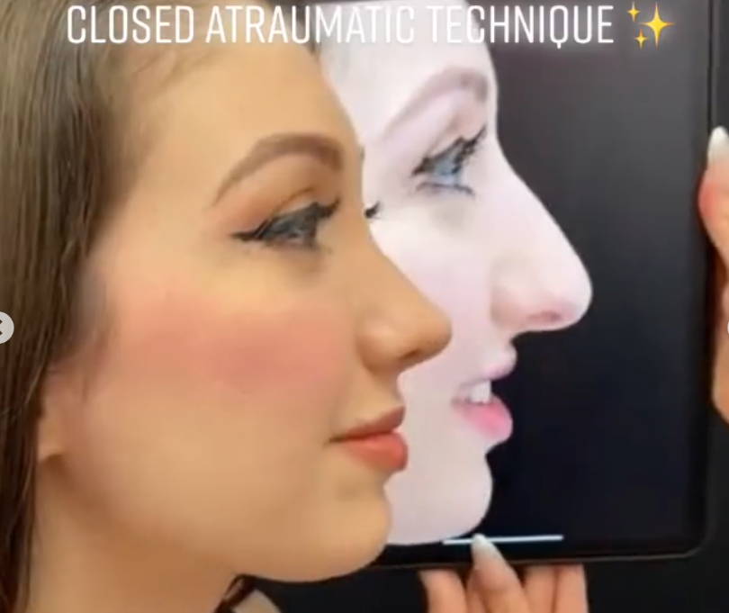 A side profile image of the patient before and after rhinoplasty, dated June 21, 2022 | Source: Instagram/drkassir