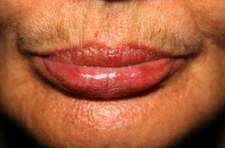 Vellos faciales en mujer. | Imagen: Shutterstock