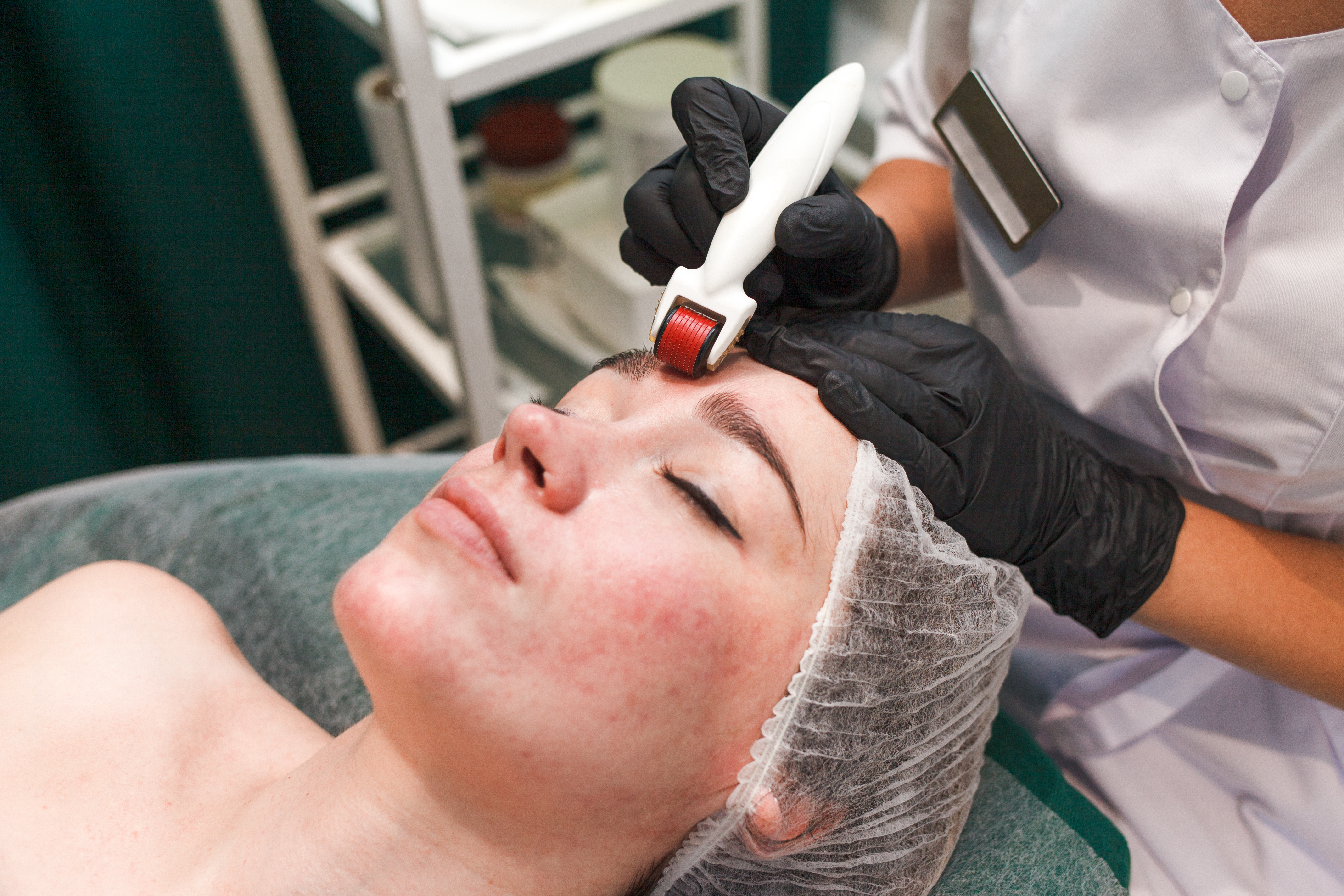 A dermatologist dermarolling the areas around the eyebrows | Source: Getty Images