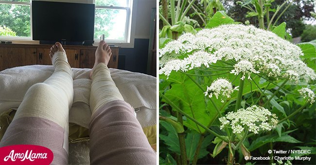 Woman suffers severe burns after coming into contact with common plant