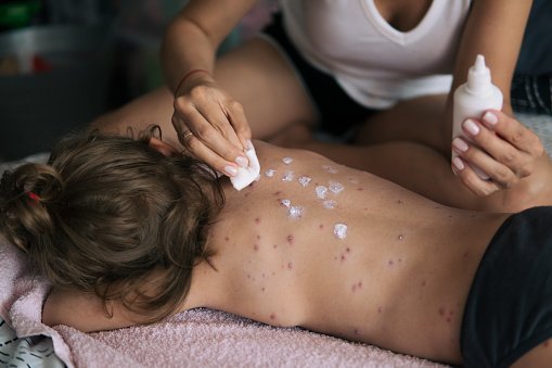 Child with Measles | Photo: Getty Images Child with Measles | Photo: Getty Images
