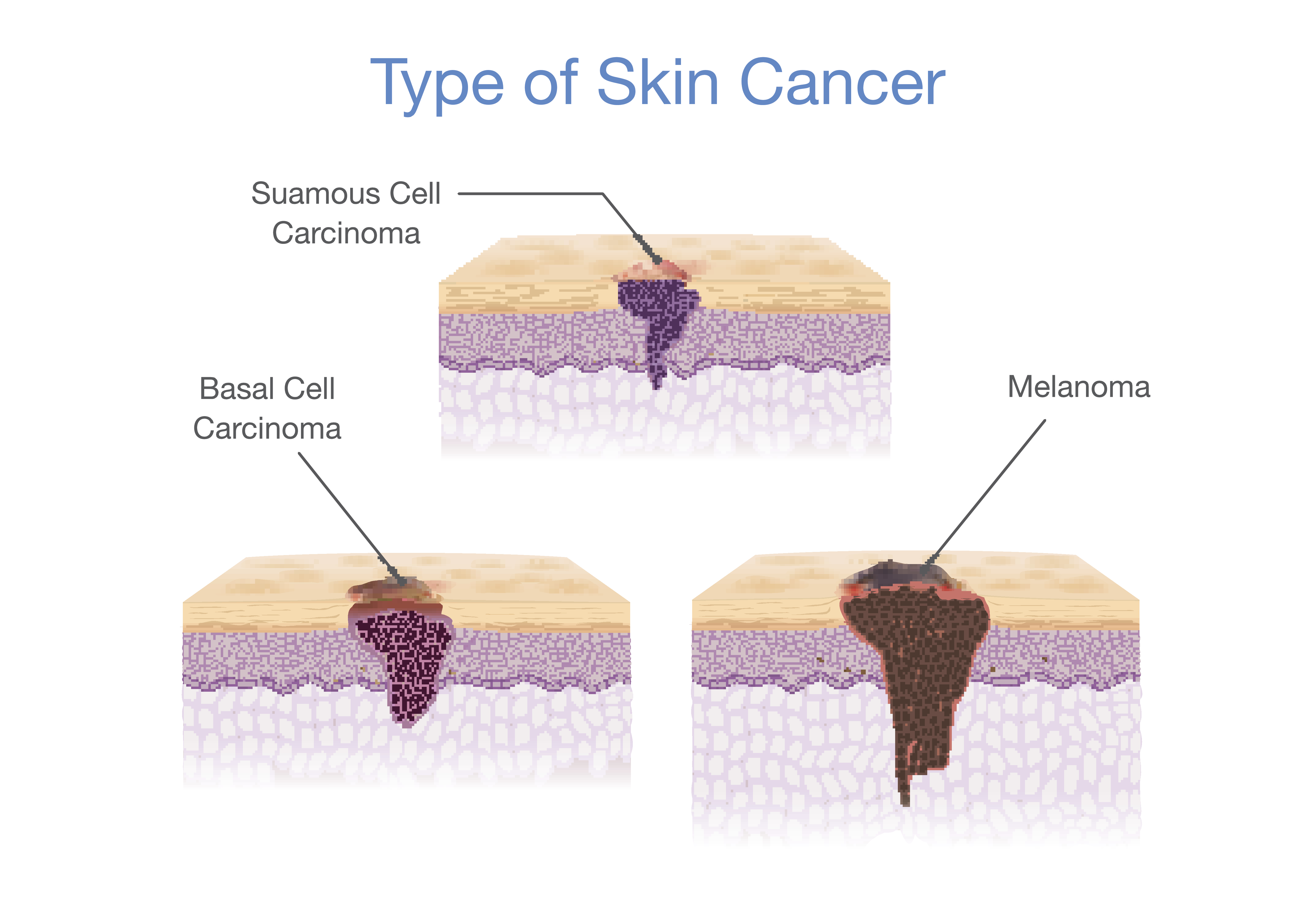 Types of skin cancer illustrated in 3D vector style Medical depiction | Source: Getty Images