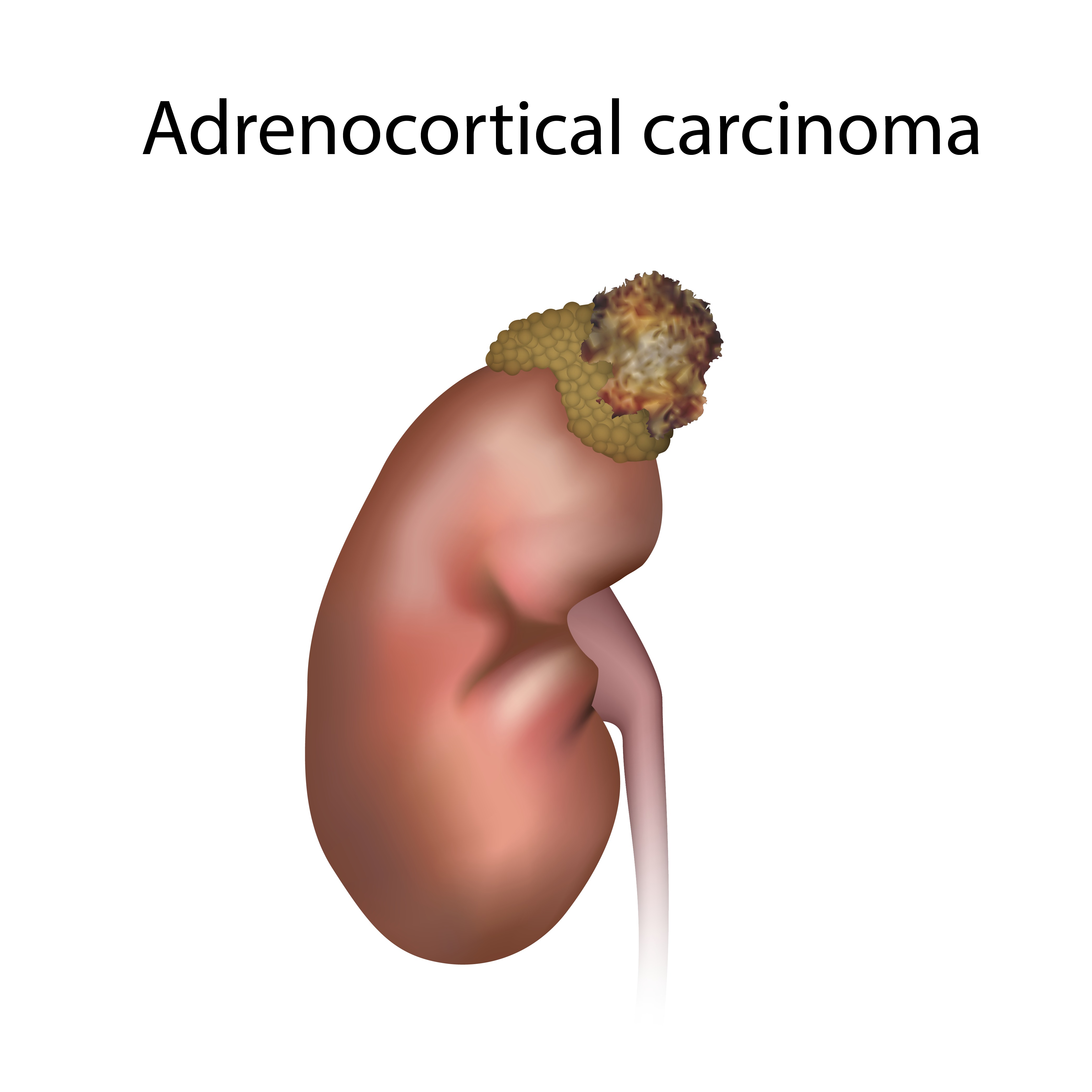 Illustration of adrenocortical carcinoma | Source: Getty Images