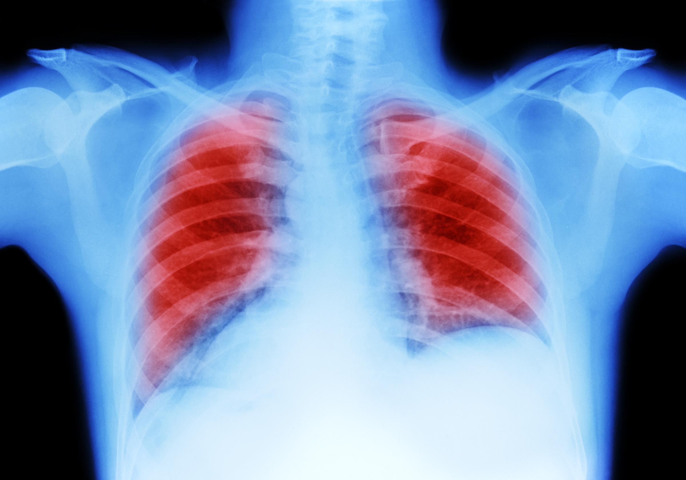 An x-ray of lungs | Source: Getty Images