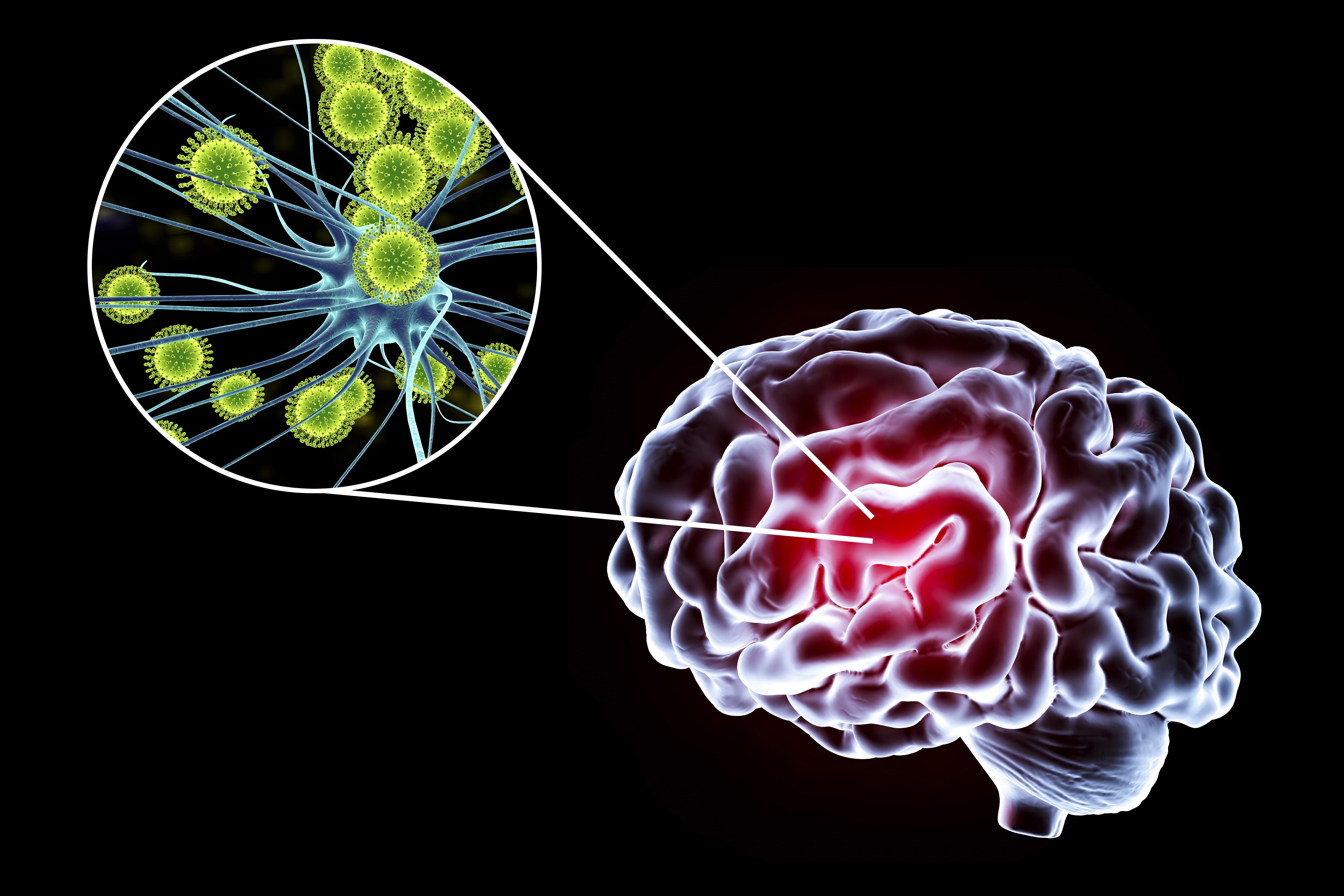 Conceptual illustration showing brain and close-up view of viruses infecting neurons | Source: Getty images
