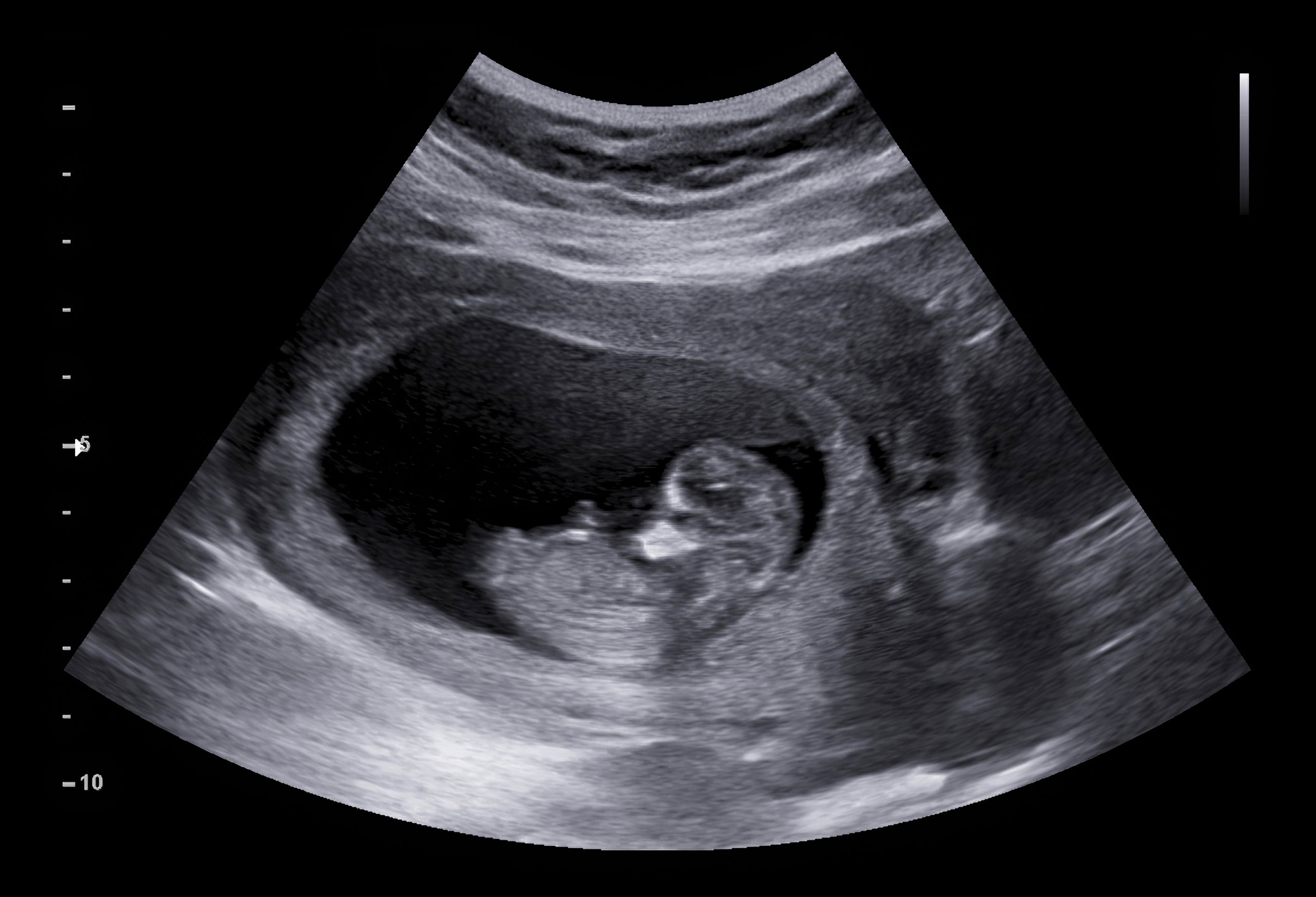 Ultrasonido de feto en el vientre. | Foto: Shutterstock