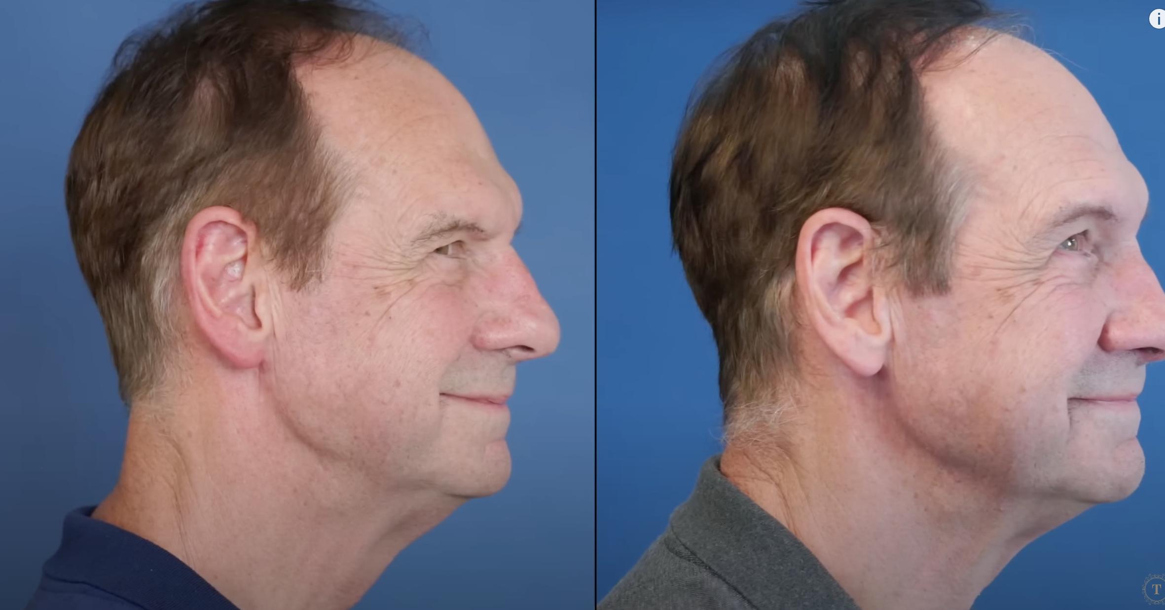 Barry Wolf before and after surgery, dated January 16, 2025 | Source: YouTube/@Dr.Truesdale