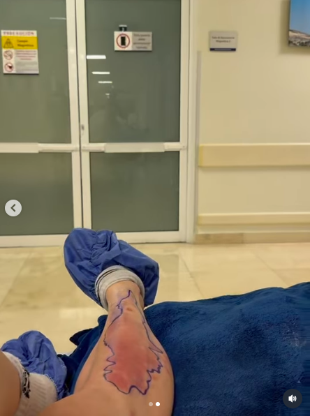 How Taylor Momsen's leg looked after the poisonous spider bite, posted on April 15, 2026. | Source: Instagram/taylormomsen