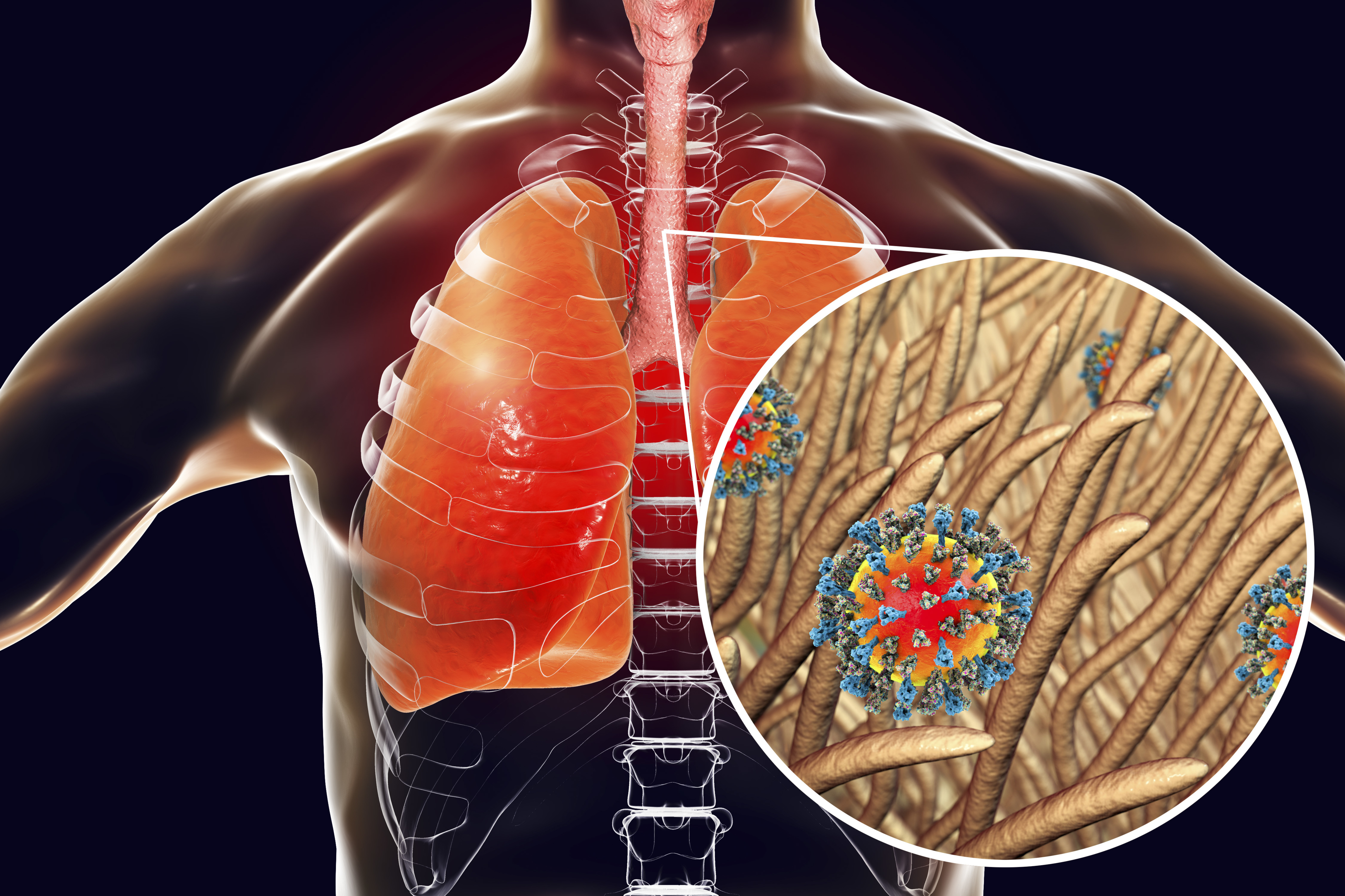 A stock illustration of pneumonia caused by measles viruses | Source: Getty Images